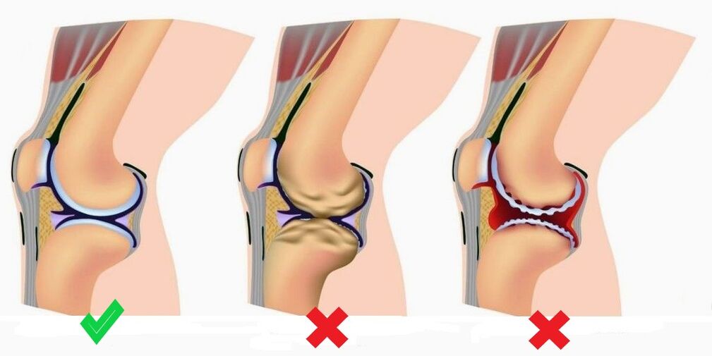 Depanten verhindert die Entwicklung von Arthritis und Arthrose