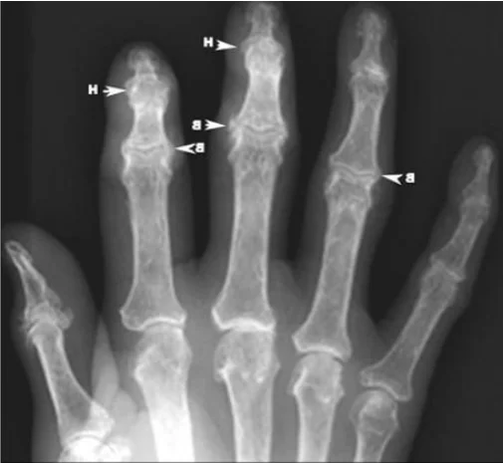 Osteophyten bei Arthrose der Fingergelenke im Röntgenbild