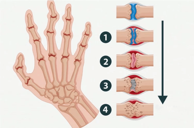 Stadien der rheumatoiden Arthritis, die die Fingergelenke betrifft