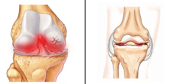 Arthrosevergleich von Arthritis