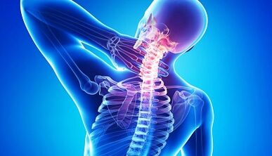 Komplikationen der Osteochondrose der Halswirbelsäule