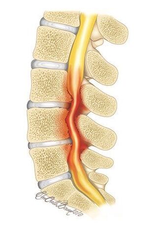 Bei einer Osteochondrose der Brustwirbelsäule kommt es zu einer Kompression des Wirbelkanals
