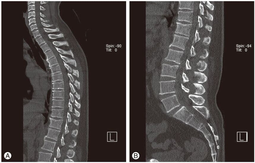 Deformation der Bandscheiben auf MRT-Bildern bei thorakaler Osteochondrose