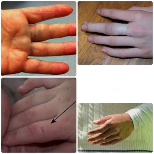 Prellungen und Brüche der Finger sind durch Gelenkschmerzen und Schwellungen gekennzeichnet