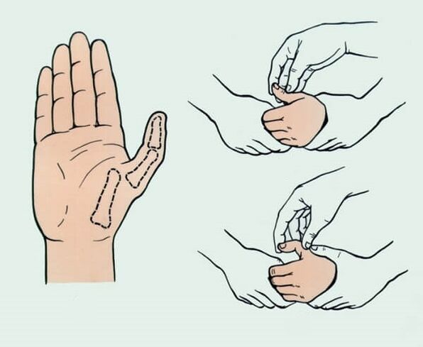 Reposition eines ausgerenkten Fingers, notwendig zur Beseitigung von Gelenkschmerzen