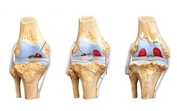 Entwicklungsstadien der Arthrose des Kniegelenks