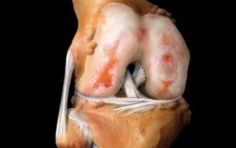 Was ist Arthrose des Kniegelenks
