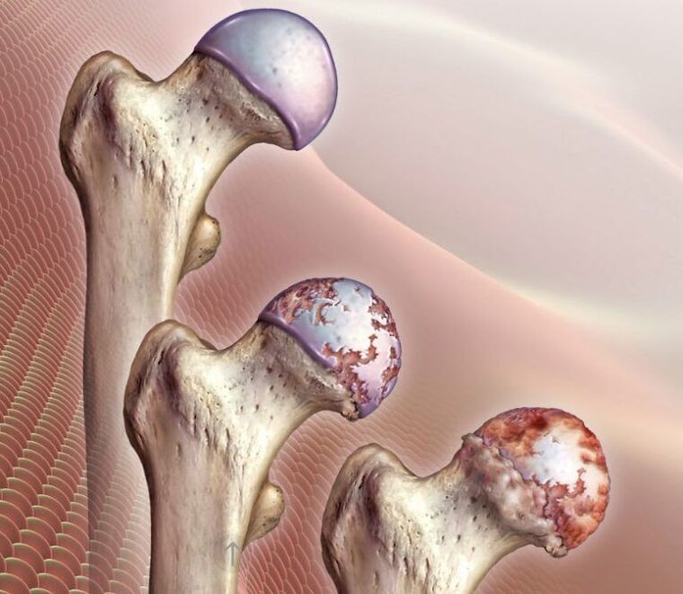 Arthrose des Hüftgelenks in unterschiedlichem Ausmaß