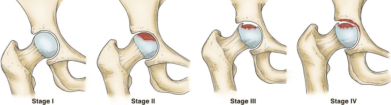 Arthrosegrade des Hüftgelenks