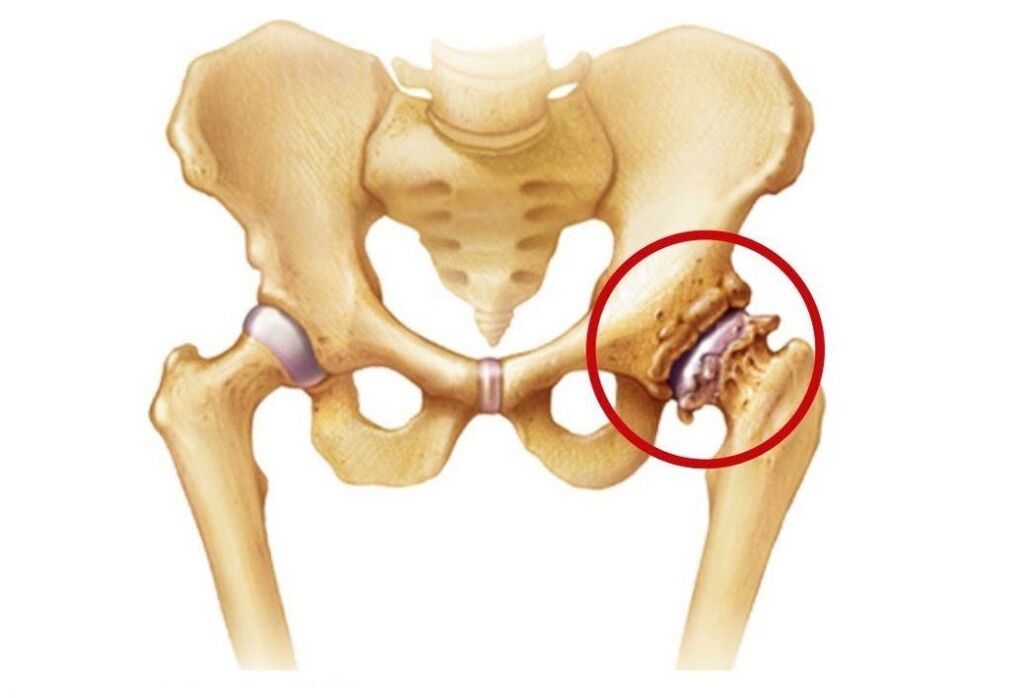 Hüftgelenk von Arthrose betroffen