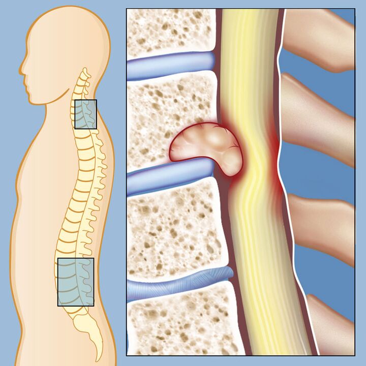 Bösartiger Tumor als Ursache für starke Lendenschmerzen